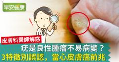 疣是良性腫瘤不易病變？3特徵別誤認，當心皮膚癌前兆