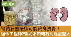 腎結石無感卻可能終身洗腎！退休工程師2徵兆才知結石比雞蛋還大