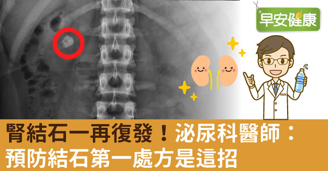 腎結石一再復發！泌尿科醫師：預防結石第一處方是這招