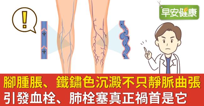 長期腳腫脹、鐵鏽色沉澱不只是靜脈曲張！引發血栓、肺栓塞真正禍首是它