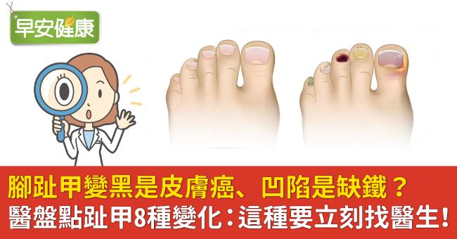 腳趾甲變黑是皮膚癌、凹陷是缺鐵？醫盤點趾甲8種變化：這種要立刻找醫生！